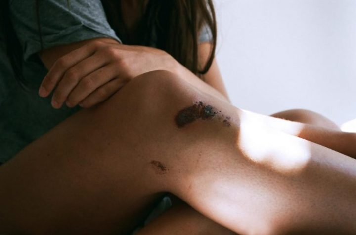 dills-grazed-knee-berlin-2015-768x509